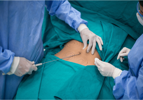 wp_eth_liposuction